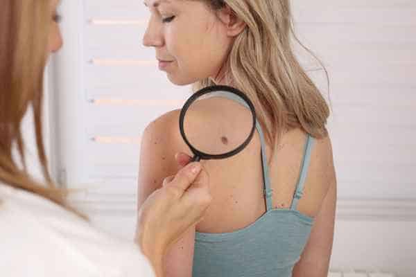 What Are Traditional Skin Lesion Removal Methods Bradford-on-Avon?