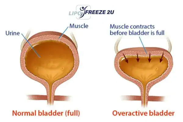 diagram of overactive bladder treatment Bradford-on-Avon
