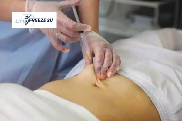 How Does Aqualyx Fat Dissolving Injection Work to Break Down Fat Bradford-on-Avon?
