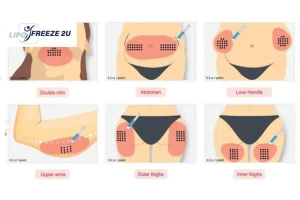 Benefits of Choosing Aqualyx for Fat Reduction Bradford-on-Avon