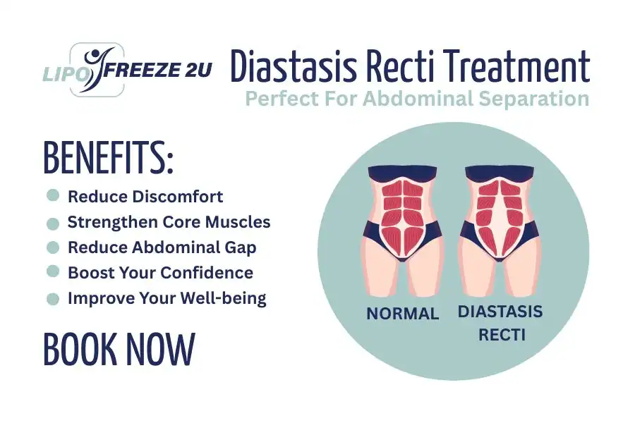 Benefits of body toning treatment Bradford-on-Avon for Diastasis recti