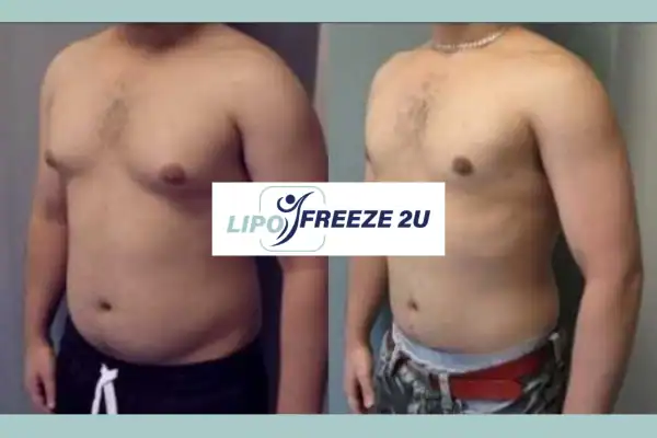 How Long Does It Take to See Results Bradford-on-Avon?