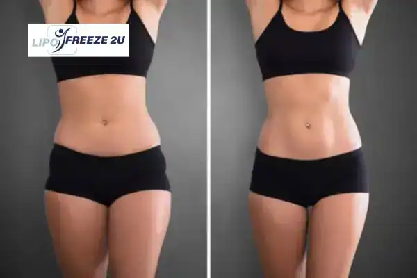 How Can LIPO FREEZE 2U Support Your Post-Pregnancy Body Recovery Bradford-on-Avon?