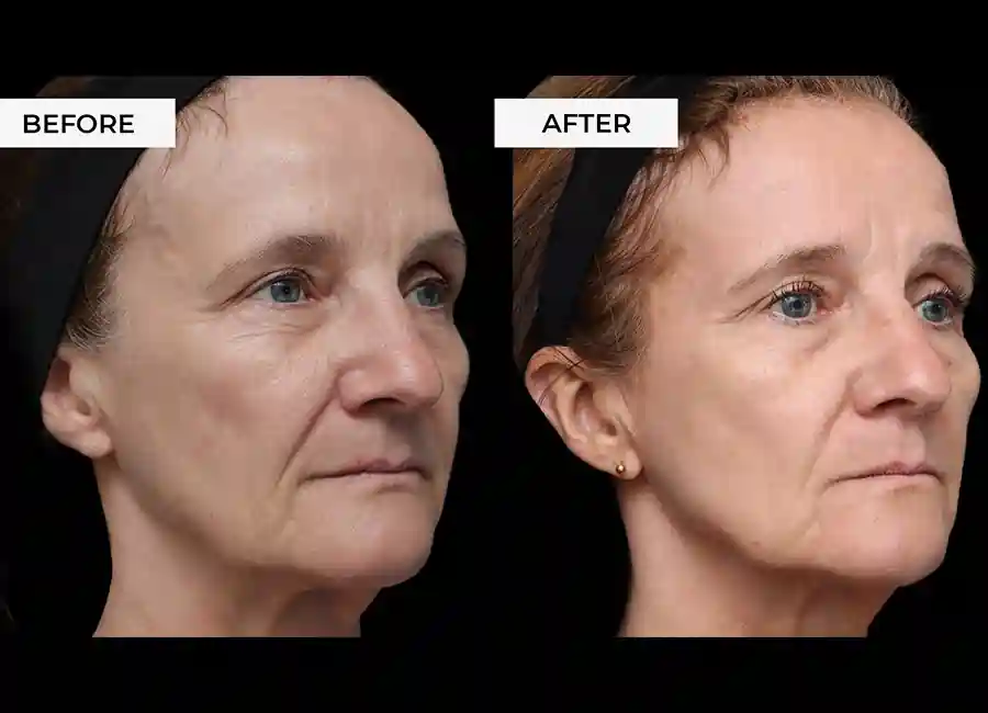 How Many RF Microneedling Sessions Will You Need to See a Difference Bradford-on-Avon?