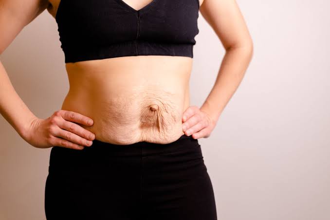 Is Surgery Really the Only Way to Repair Diastasis Recti Bradford-on-Avon?
