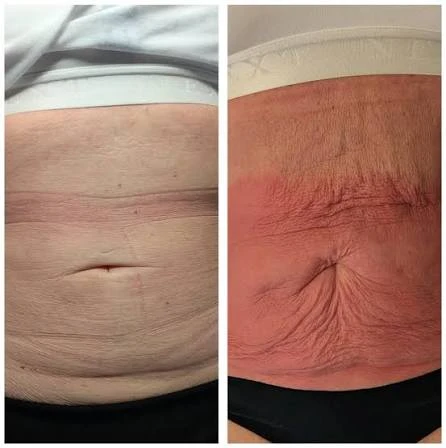How Does RF Microneedling Improve Crepey, Thin and Uneven Skin Texture Bradford-on-Avon?