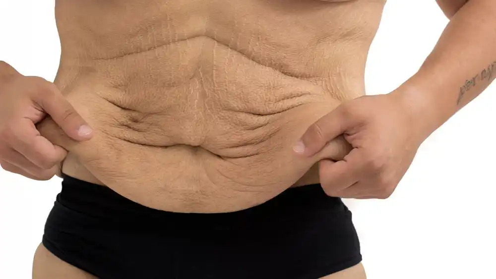 RF Microneedling for Loose Skin: How Can It Help Tighten and Reshape the Skin Bradford-on-Avon?